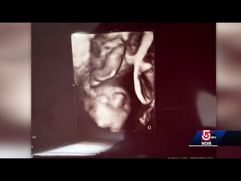 Woman expecting 1 in 70M set of quadruplets