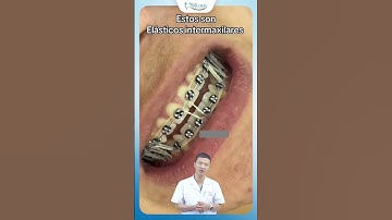 Đeo Chun Đóng Khớp Niềng Răng | Bác Sĩ Yên