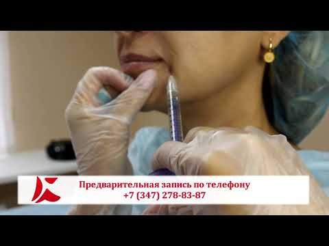 Контурная пластика носогубных
