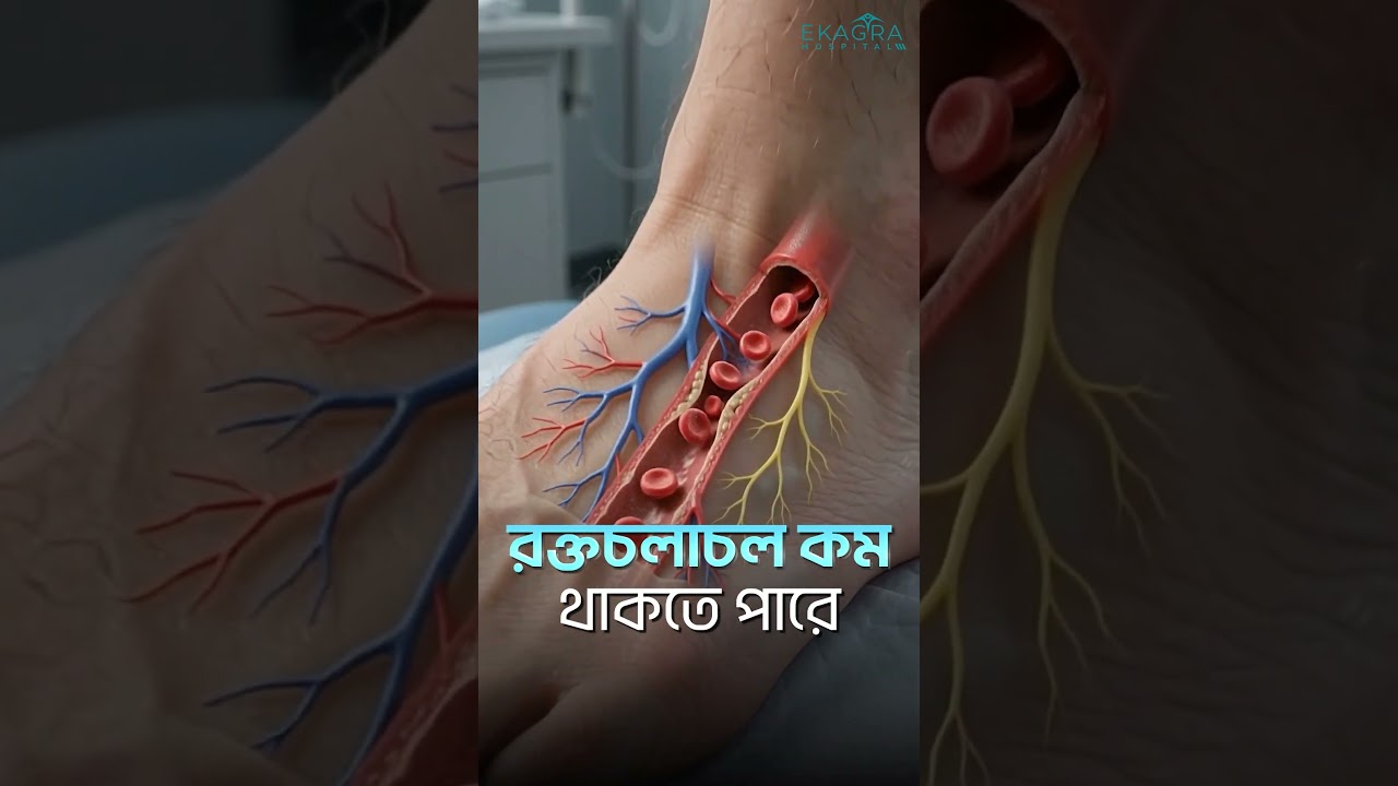 ডায়াবেটিস রোগীর ছোট ক্ষতও বড় ঝুঁকির কারণ হতে পারে #EkagraHospital  #diabeticfoot #dhanmondi