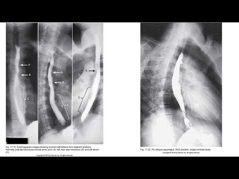 Radiographic Positioning of the Esophagus