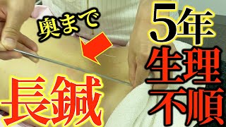 【超長い鍼おしり　生理】最悪５年の生理不順には20cmの長い鍼でお尻の奥にある神経を刺激。生理痛、瘀血でガチガチ、カラダはオッサン化を吸い玉と鍼で治す【横浜元町　鍼灸】