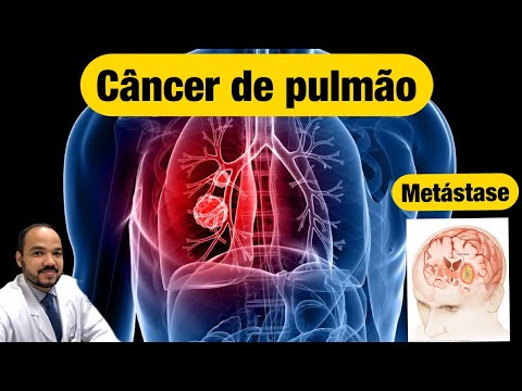 Vídeo: Prognóstico Do Câncer De Pulmão Em Estágio 4: Taxa De Sobrevivência, Sintomas E Muito Mais