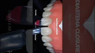 Details Diastema closure using Tetric plus+Bioclear matrix #ivoclar #tetricplus #bioclear #dentistry News