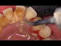 大規模な歯石の洗浄-歯石の除去 🦷 [Remove Massive Hidden Teeth Tartar] #098 DentalClinic