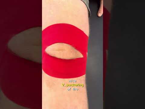 Medial Patella Glide Taping with K Tape