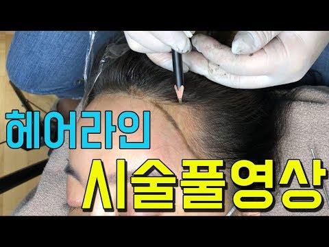 헤어라인 시술풀영상