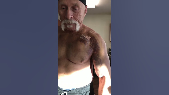 What happens after pacemaker surgery in 2022?