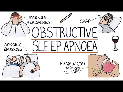 Video: Obstructive Sleep Apnea