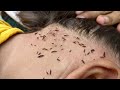 Wow there are a lot of lice from black hair  getting out all lice from head