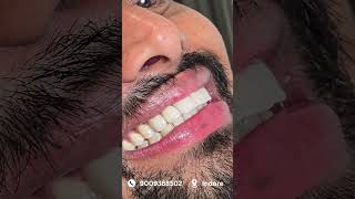 Smile Design Veneers Transformation 😍 Confidence Changed Instantly! | Indore