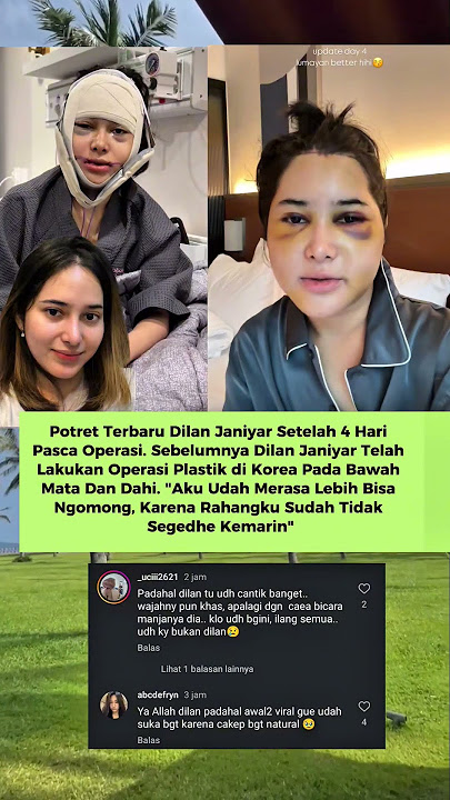 Potret Terbaru Dilan Janiyar Pasca 4 Hari Operasi Plastik Di Korea