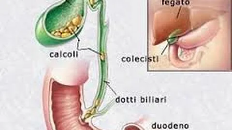 Cosa fare con calcoli alla colecisti?