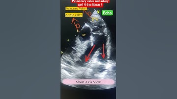 Pulmonary Valve & artery Echo view l Shorts Axis view #echo #heartattack #shorts