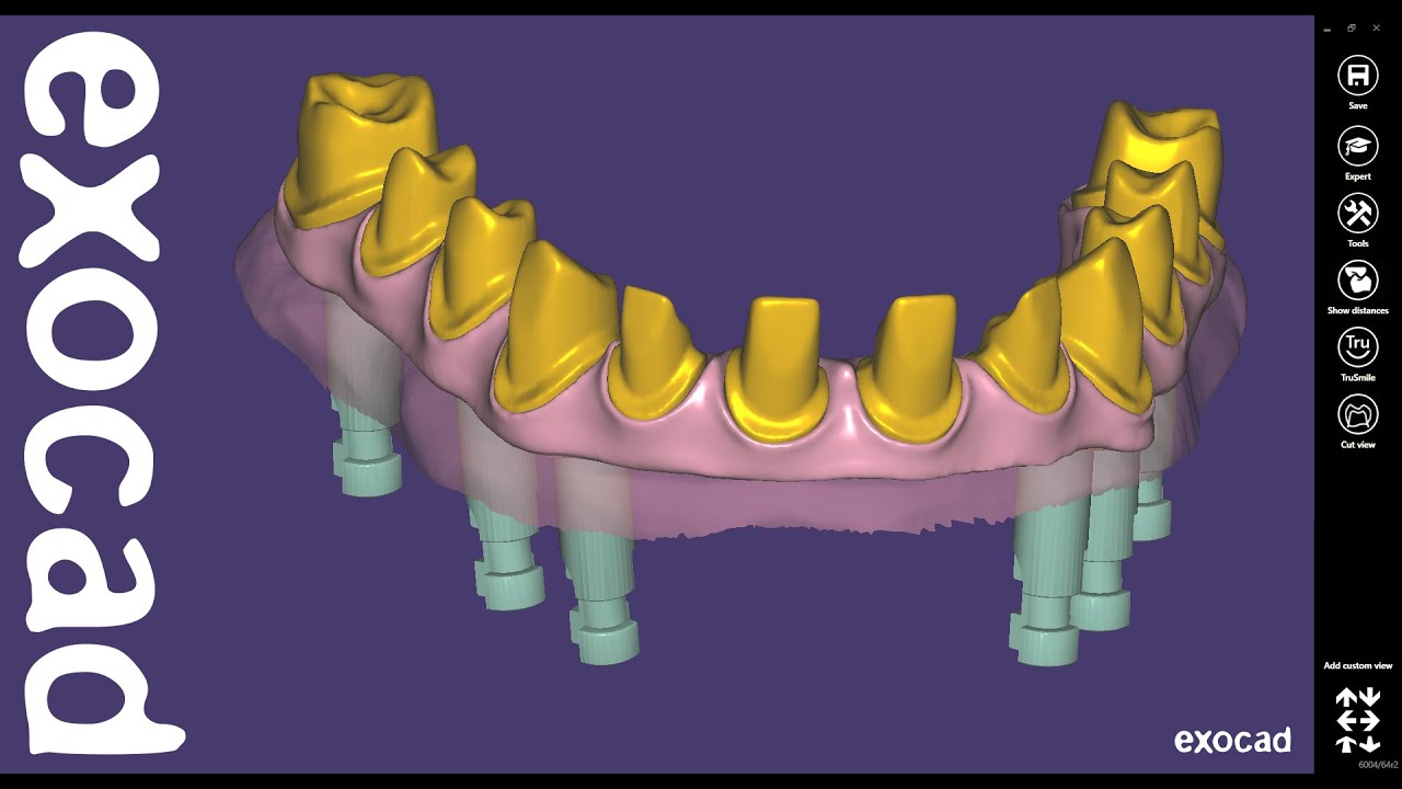 exocad implant library