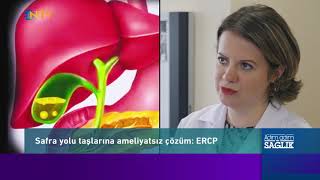 Safra Yolu Taşlarının Endoskopik Tedavisi: ERCP