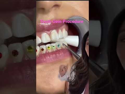 Video: Kaip taikyti dantų brangakmenius: 14 žingsnių (su nuotraukomis)