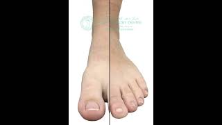 Why Runners Get Black or Damaged Toenails (Even in Good Shoes) #ToenailDamage