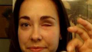 Removing and replacing prosthetic eye Artificial Eye Removal With Suction Cup