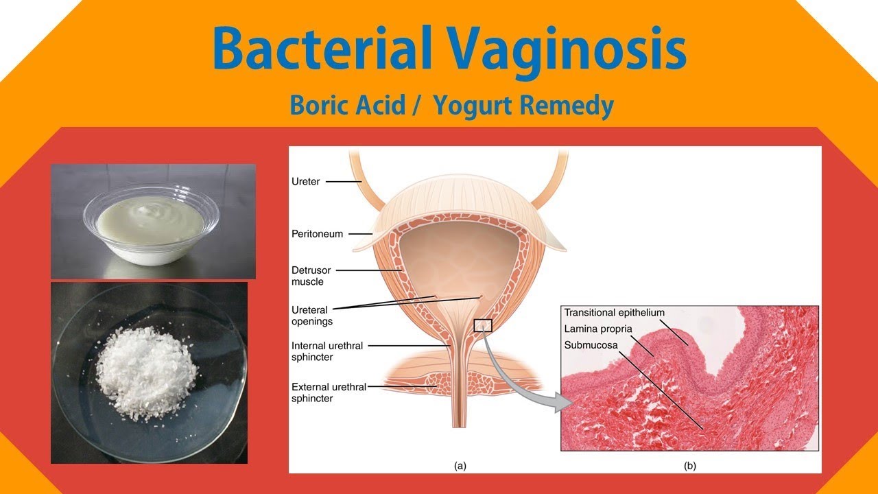 Home Remedies for Bacterial Vaginosis with Boric Acidity / Yogurt YouTube