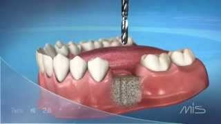 MIS M4 - Процедура установки импланта(Купить имплант Мис М4 в Украине http://www.all-dent.com.ua/product/mis-m4., 2015-11-01T20:50:44.000Z)