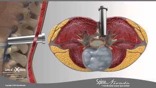 Lumbar Microdiscectomy  Spine Center Northern Nevada, Northern California  Spine Surgery