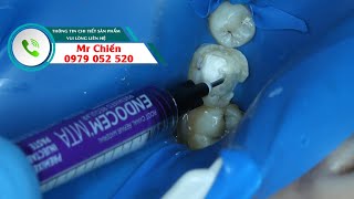CHE TỦY TRỰC TIẾP BẰNG ENDOCEM MTA PREMIXED