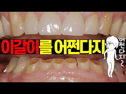 Teeth grinding during sleep! Come if you&rsquo;re stressed  |  Sleep bruxism explained by a dentist!