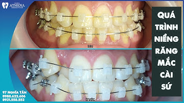 QUÁ TRÌNH NIỀNG KHIẾN RĂNG BẠN THAY ĐỔI NHƯ THẾ NÀO ??? || MẮC CÀI SỨ || NHA KHOA ATHENA