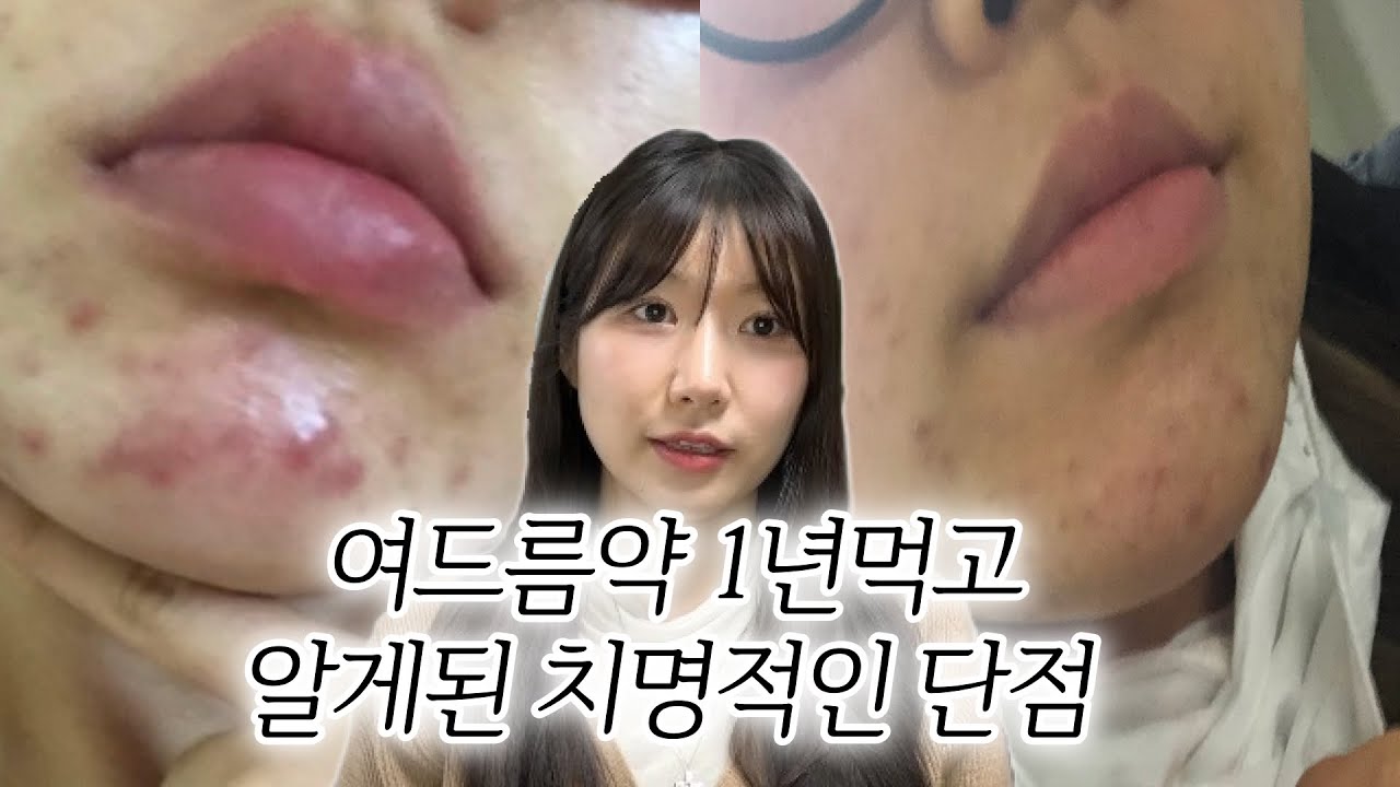 병원에서는 말해주지 않는 이소티논의 부작용