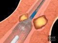 Evolution esophageal controlledrelease stent  partially covered endoscopic animation