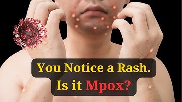 Mpox Explained: What You NEED to Know About Mpox. #mpox #emergency #who #virus