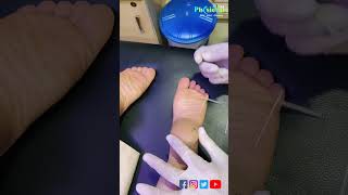 Severe Heel Pain Treatment|Dry Needling & Accupuncture Treatment for Heel Paindryneedlingheelpain