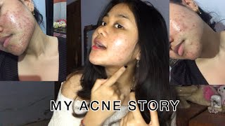 MY ACNE STORY ll PERJUANGAN MELAWAN JERAWAT - AKHIRNYA !!!