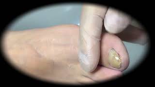 Ingrown Toenails Treatment Satisfying Pedicure Manicure #6