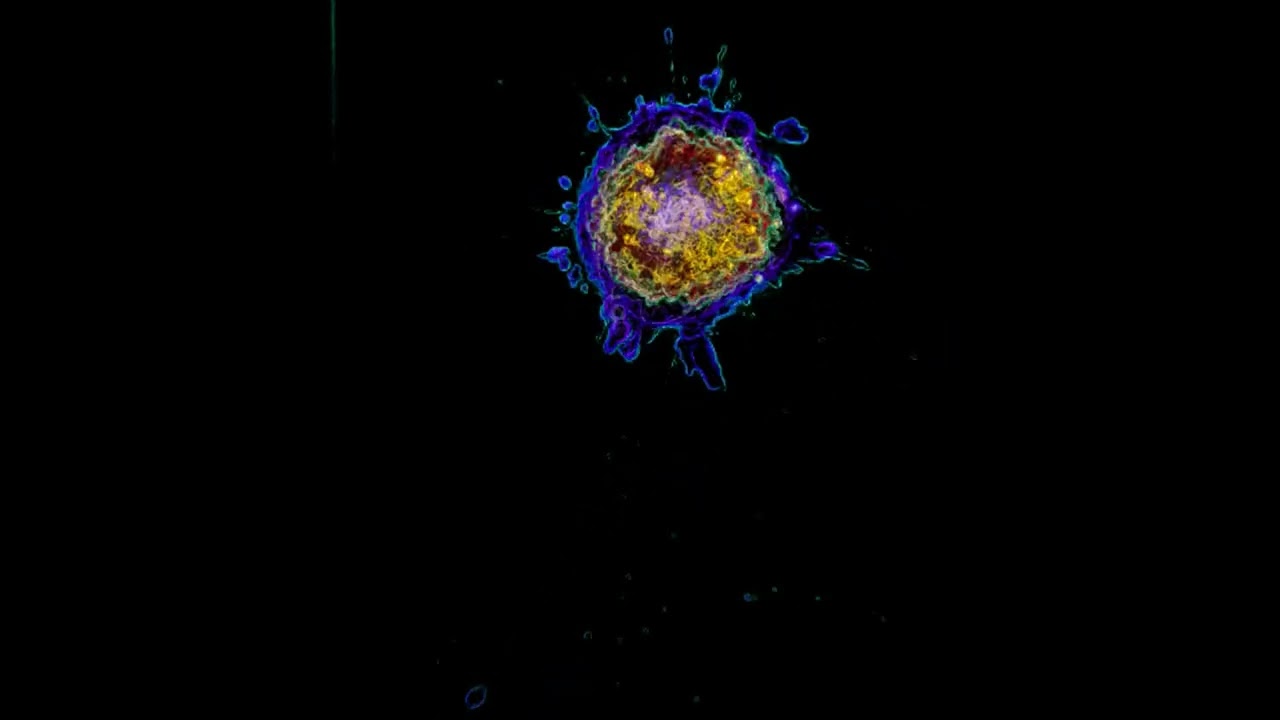 Digitally stained human melanoma cancer cell undergoing apoptosis