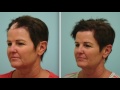 Hair Transplant Testimonial for Scar Repair/Cancer Reconstruction