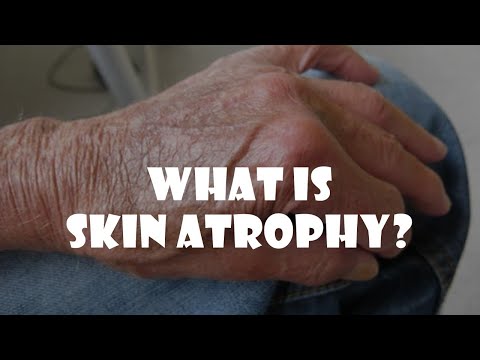 Video: Skin Atrophy: Symptoms, Treatment, Photo