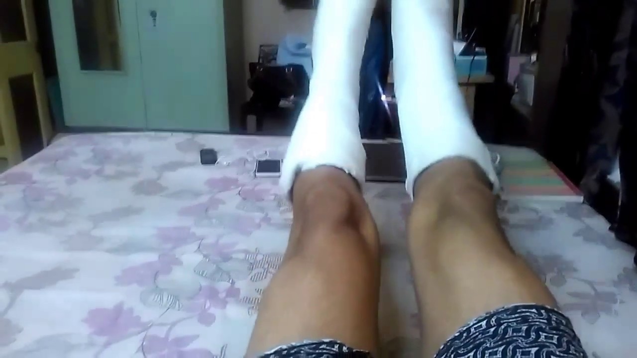 Week 3 Recovery from bilateral calcaneus fracture with ORIF on right