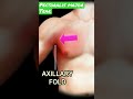 Pectoralis major tear #shorts