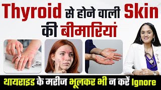 थायराइड की कमी से होने वाली त्वचा समस्याएं |Hypothyroidism/Hyperthyroidism से होने वाली Skin Disease