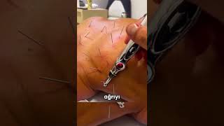 Bir İğneyle Gelen Rahatlık Kuru İğneleme Nedir?