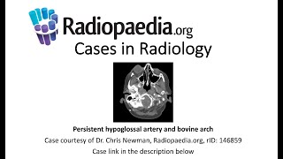 Persistent Hypoglossal Artery And Bovine Arch Radiopaedia.org Cases In Radiology