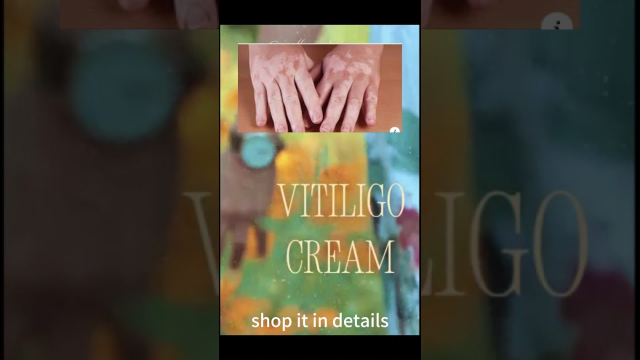 This cream can actually remove vitiligo  ????? !!!!!!!!!!!!!