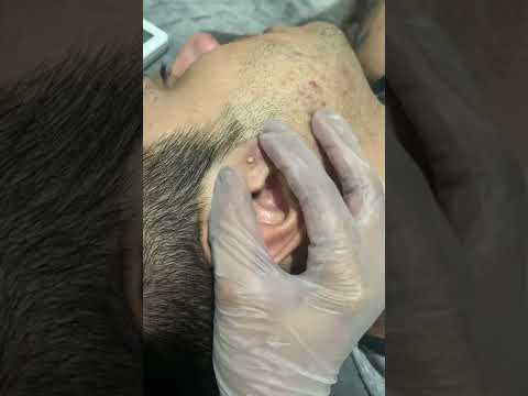 How To Get Rid of Acne Scars & Blackheads 4K