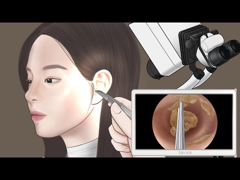 [ASMR] 편안한 귀 청소 / 대왕 귀지 제거 /Ear cleaning and Big ear wax removal