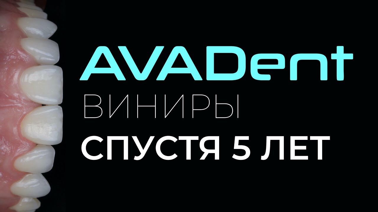 AVADent. Виниры спустя 5 лет.