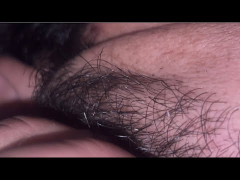 Extreme Ingrown Beard Removal | ASMR Sounds Calm & Satisfying Beard Grooming ASMR