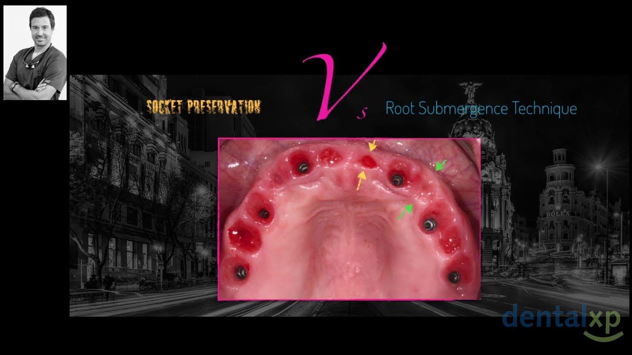 Socket Preservation vs Root Submergence Technique YouTube
