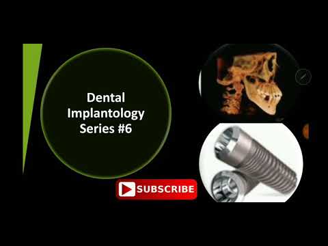 Video: Endostealimplantat: Dentalimplantattyper Og -procedurer